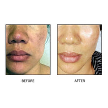 Load image into Gallery viewer, All-In-One Dark Spot Clearer Set